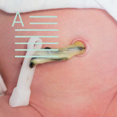 Delayed Cord Clamping After Birth