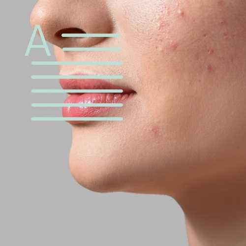 Acne in Pregnancy: Causes & Treatments