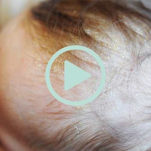 Cradle Cap: Diagnosing and Treating in Newborns